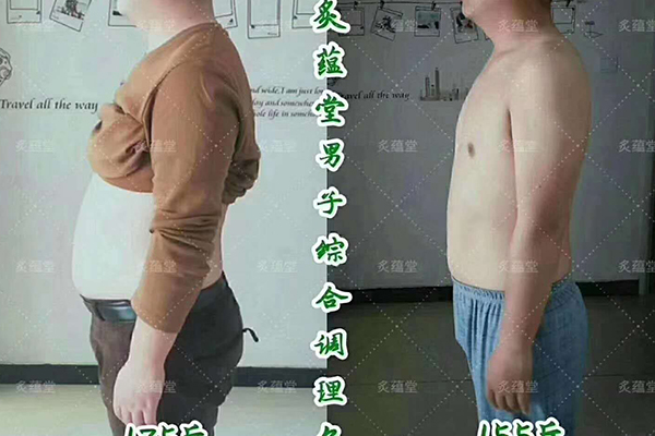上海中药热敷包多囊卵巢综合症减肥有用吗